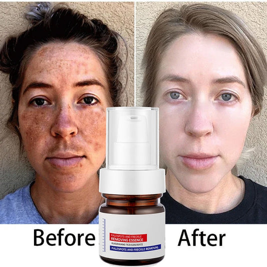 🔥FLASH SALE 50%：5-second brightening rescue: Dark spots disappear, blemishes fade, and skin becomes radiant! Vitamin C Whitening Freckles ESSENCE(3 HOURS LEFT!)