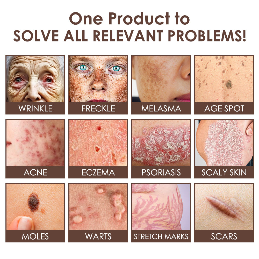 🇺🇸𝗚𝘂𝗮𝗿𝗮𝗻𝘁𝗲𝗲𝗱 𝗻𝗼 𝗿𝗲𝗰𝘂𝗿𝗿𝗲𝗻𝗰𝗲🌿𝐙𝐯𝐨𝐞𝐯𝐨® 𝐓𝐚𝐥𝐥𝐨𝐰 𝐁𝐞𝐞 𝐕𝐞𝐧𝐨𝐦 𝐒𝐤𝐢𝐧 𝐑𝐞𝐬𝐭𝐨𝐫𝐚𝐭𝐢𝐨𝐧 𝐂𝐫𝐞𝐚𝐦🇺🇸𝗠𝗮𝗱𝗲 𝗜𝗻 𝗨𝗦𝗔