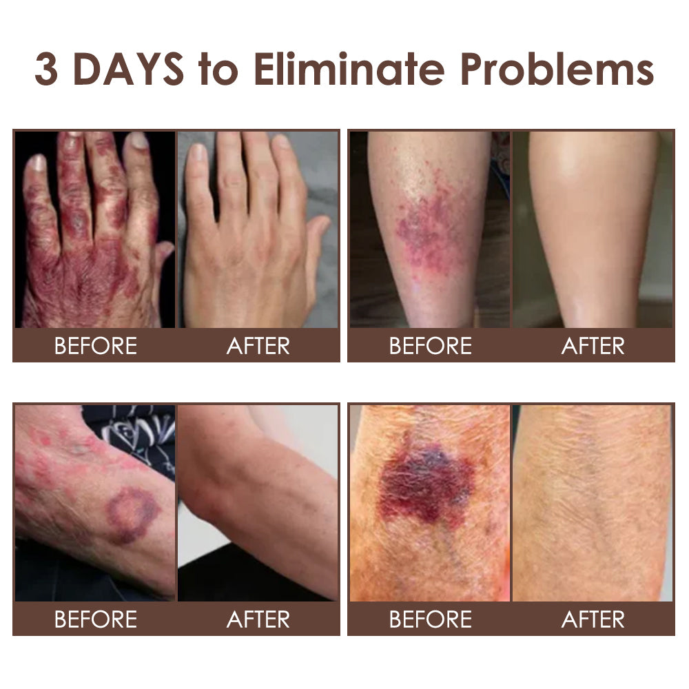 🇺🇸𝗚𝘂𝗮𝗿𝗮𝗻𝘁𝗲𝗲𝗱 𝗻𝗼 𝗿𝗲𝗰𝘂𝗿𝗿𝗲𝗻𝗰𝗲🌿𝐙𝐯𝐨𝐞𝐯𝐨® 𝐓𝐚𝐥𝐥𝐨𝐰 𝐁𝐞𝐞 𝐕𝐞𝐧𝐨𝐦 𝐒𝐤𝐢𝐧 𝐑𝐞𝐬𝐭𝐨𝐫𝐚𝐭𝐢𝐨𝐧 𝐂𝐫𝐞𝐚𝐦🇺🇸𝗠𝗮𝗱𝗲 𝗜𝗻 𝗨𝗦𝗔