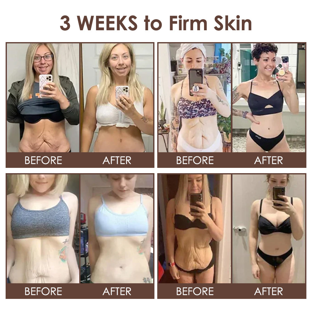 🇺🇸𝗚𝘂𝗮𝗿𝗮𝗻𝘁𝗲𝗲𝗱 𝗻𝗼 𝗿𝗲𝗰𝘂𝗿𝗿𝗲𝗻𝗰𝗲🌿𝐙𝐯𝐨𝐞𝐯𝐨® 𝐓𝐚𝐥𝐥𝐨𝐰 𝐁𝐞𝐞 𝐕𝐞𝐧𝐨𝐦 𝐒𝐤𝐢𝐧 𝐑𝐞𝐬𝐭𝐨𝐫𝐚𝐭𝐢𝐨𝐧 𝐂𝐫𝐞𝐚𝐦🇺🇸𝗠𝗮𝗱𝗲 𝗜𝗻 𝗨𝗦𝗔