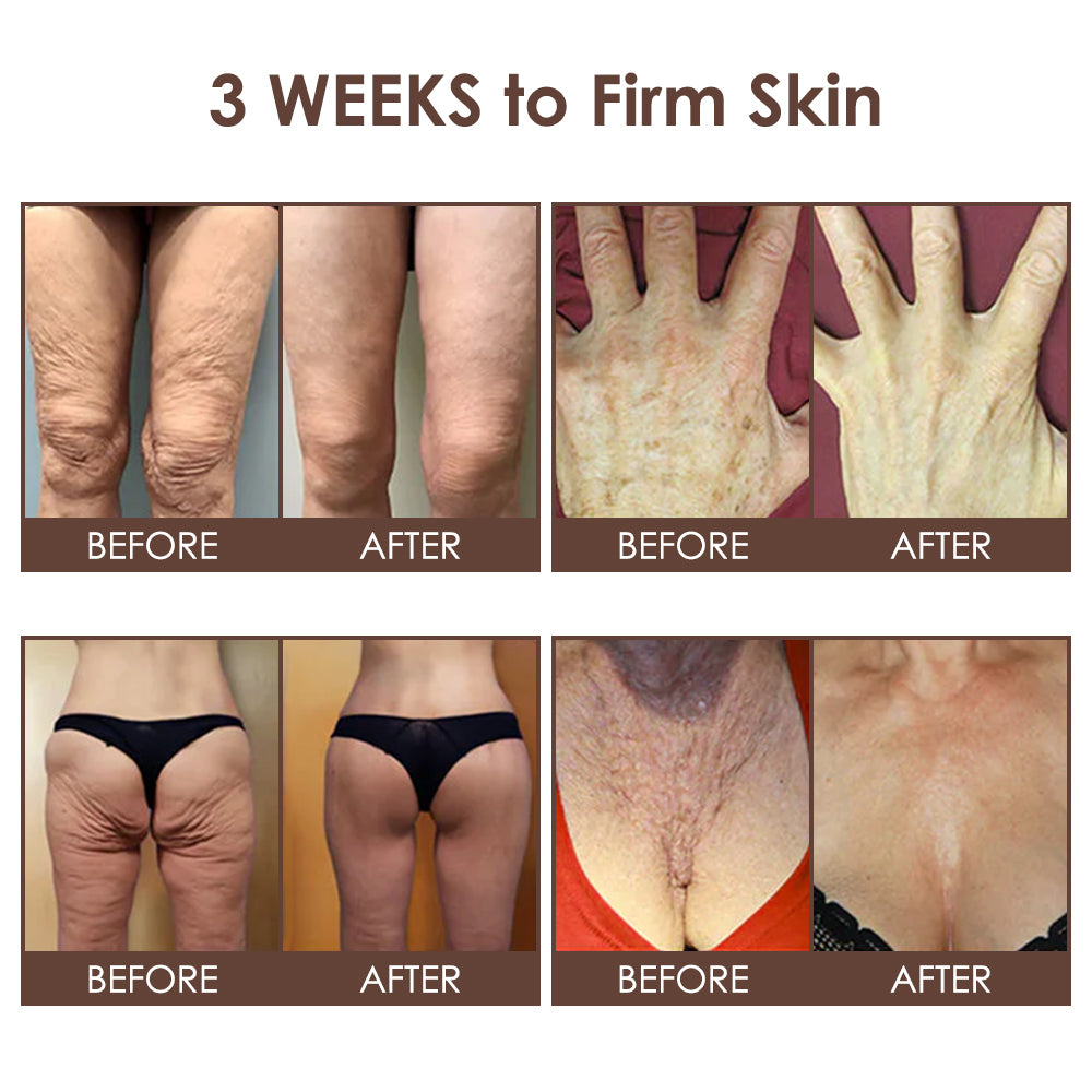 🇺🇸𝗚𝘂𝗮𝗿𝗮𝗻𝘁𝗲𝗲𝗱 𝗻𝗼 𝗿𝗲𝗰𝘂𝗿𝗿𝗲𝗻𝗰𝗲🌿𝐙𝐯𝐨𝐞𝐯𝐨® 𝐓𝐚𝐥𝐥𝐨𝐰 𝐁𝐞𝐞 𝐕𝐞𝐧𝐨𝐦 𝐒𝐤𝐢𝐧 𝐑𝐞𝐬𝐭𝐨𝐫𝐚𝐭𝐢𝐨𝐧 𝐂𝐫𝐞𝐚𝐦🇺🇸𝗠𝗮𝗱𝗲 𝗜𝗻 𝗨𝗦𝗔