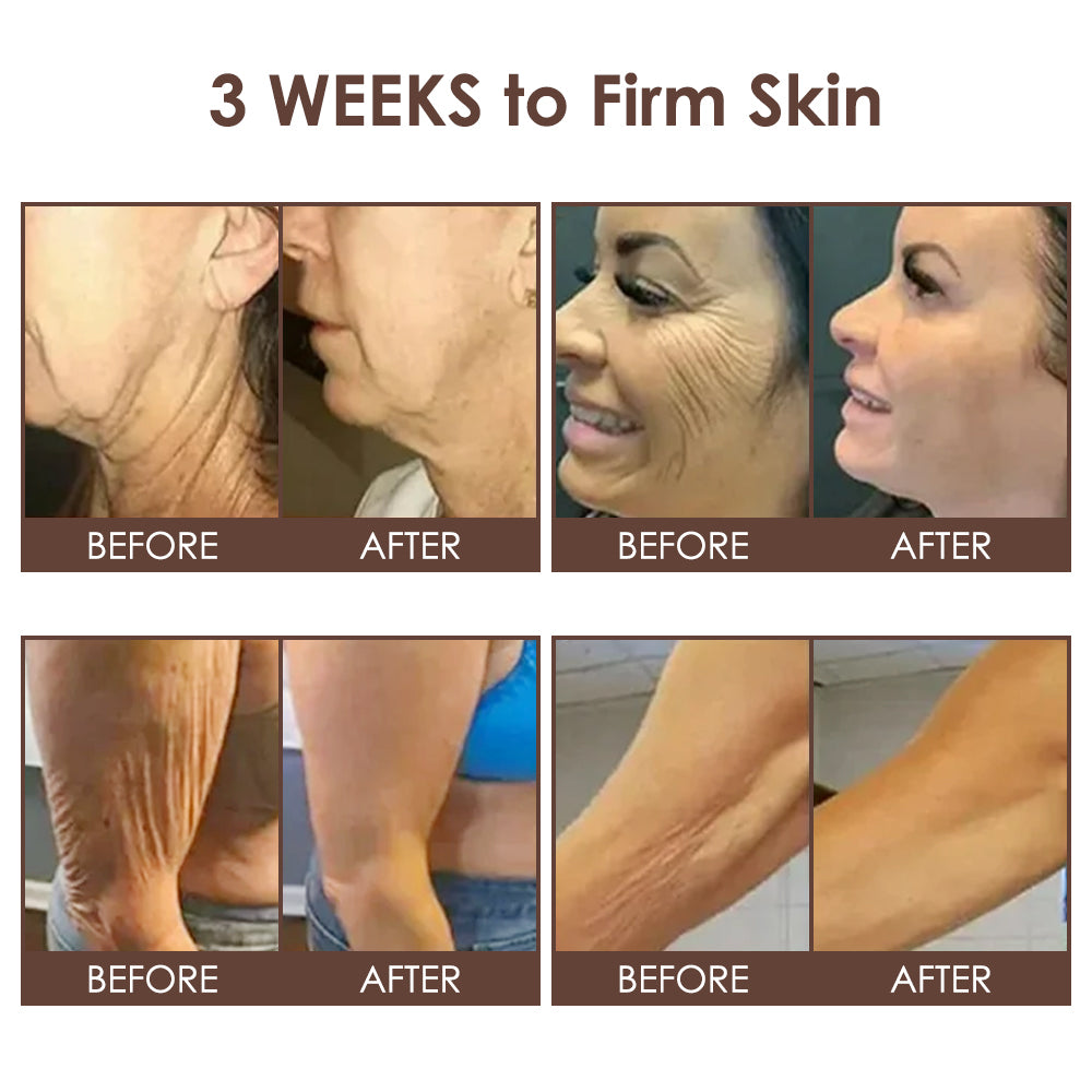 🇺🇸𝗚𝘂𝗮𝗿𝗮𝗻𝘁𝗲𝗲𝗱 𝗻𝗼 𝗿𝗲𝗰𝘂𝗿𝗿𝗲𝗻𝗰𝗲🌿𝐙𝐯𝐨𝐞𝐯𝐨® 𝐓𝐚𝐥𝐥𝐨𝐰 𝐁𝐞𝐞 𝐕𝐞𝐧𝐨𝐦 𝐒𝐤𝐢𝐧 𝐑𝐞𝐬𝐭𝐨𝐫𝐚𝐭𝐢𝐨𝐧 𝐂𝐫𝐞𝐚𝐦🇺🇸𝗠𝗮𝗱𝗲 𝗜𝗻 𝗨𝗦𝗔