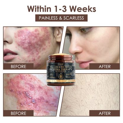 🇺🇸𝗚𝘂𝗮𝗿𝗮𝗻𝘁𝗲𝗲𝗱 𝗻𝗼 𝗿𝗲𝗰𝘂𝗿𝗿𝗲𝗻𝗰𝗲🌿𝐙𝐯𝐨𝐞𝐯𝐨® 𝐓𝐚𝐥𝐥𝐨𝐰 𝐁𝐞𝐞 𝐕𝐞𝐧𝐨𝐦 𝐒𝐤𝐢𝐧 𝐑𝐞𝐬𝐭𝐨𝐫𝐚𝐭𝐢𝐨𝐧 𝐂𝐫𝐞𝐚𝐦🇺🇸𝗠𝗮𝗱𝗲 𝗜𝗻 𝗨𝗦𝗔