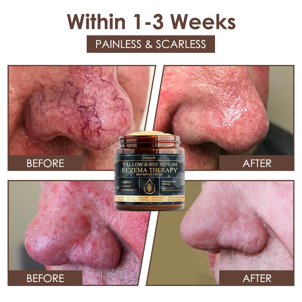 🇺🇸𝗚𝘂𝗮𝗿𝗮𝗻𝘁𝗲𝗲𝗱 𝗻𝗼 𝗿𝗲𝗰𝘂𝗿𝗿𝗲𝗻𝗰𝗲🌿𝐙𝐯𝐨𝐞𝐯𝐨® 𝐓𝐚𝐥𝐥𝐨𝐰 𝐁𝐞𝐞 𝐕𝐞𝐧𝐨𝐦 𝐒𝐤𝐢𝐧 𝐑𝐞𝐬𝐭𝐨𝐫𝐚𝐭𝐢𝐨𝐧 𝐂𝐫𝐞𝐚𝐦🇺🇸𝗠𝗮𝗱𝗲 𝗜𝗻 𝗨𝗦𝗔