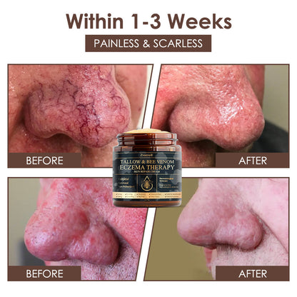 🇺🇸𝗚𝘂𝗮𝗿𝗮𝗻𝘁𝗲𝗲𝗱 𝗻𝗼 𝗿𝗲𝗰𝘂𝗿𝗿𝗲𝗻𝗰𝗲🌿𝐙𝐯𝐨𝐞𝐯𝐨® 𝐓𝐚𝐥𝐥𝐨𝐰 𝐁𝐞𝐞 𝐕𝐞𝐧𝐨𝐦 𝐒𝐤𝐢𝐧 𝐑𝐞𝐬𝐭𝐨𝐫𝐚𝐭𝐢𝐨𝐧 𝐂𝐫𝐞𝐚𝐦🇺🇸𝗠𝗮𝗱𝗲 𝗜𝗻 𝗨𝗦𝗔