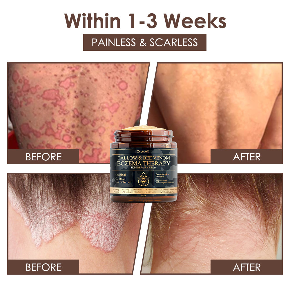 🇺🇸𝗚𝘂𝗮𝗿𝗮𝗻𝘁𝗲𝗲𝗱 𝗻𝗼 𝗿𝗲𝗰𝘂𝗿𝗿𝗲𝗻𝗰𝗲🌿𝐙𝐯𝐨𝐞𝐯𝐨® 𝐓𝐚𝐥𝐥𝐨𝐰 𝐁𝐞𝐞 𝐕𝐞𝐧𝐨𝐦 𝐒𝐤𝐢𝐧 𝐑𝐞𝐬𝐭𝐨𝐫𝐚𝐭𝐢𝐨𝐧 𝐂𝐫𝐞𝐚𝐦🇺🇸𝗠𝗮𝗱𝗲 𝗜𝗻 𝗨𝗦𝗔