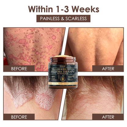 🇺🇸𝗚𝘂𝗮𝗿𝗮𝗻𝘁𝗲𝗲𝗱 𝗻𝗼 𝗿𝗲𝗰𝘂𝗿𝗿𝗲𝗻𝗰𝗲🌿𝐙𝐯𝐨𝐞𝐯𝐨® 𝐓𝐚𝐥𝐥𝐨𝐰 𝐁𝐞𝐞 𝐕𝐞𝐧𝐨𝐦 𝐒𝐤𝐢𝐧 𝐑𝐞𝐬𝐭𝐨𝐫𝐚𝐭𝐢𝐨𝐧 𝐂𝐫𝐞𝐚𝐦🇺🇸𝗠𝗮𝗱𝗲 𝗜𝗻 𝗨𝗦𝗔