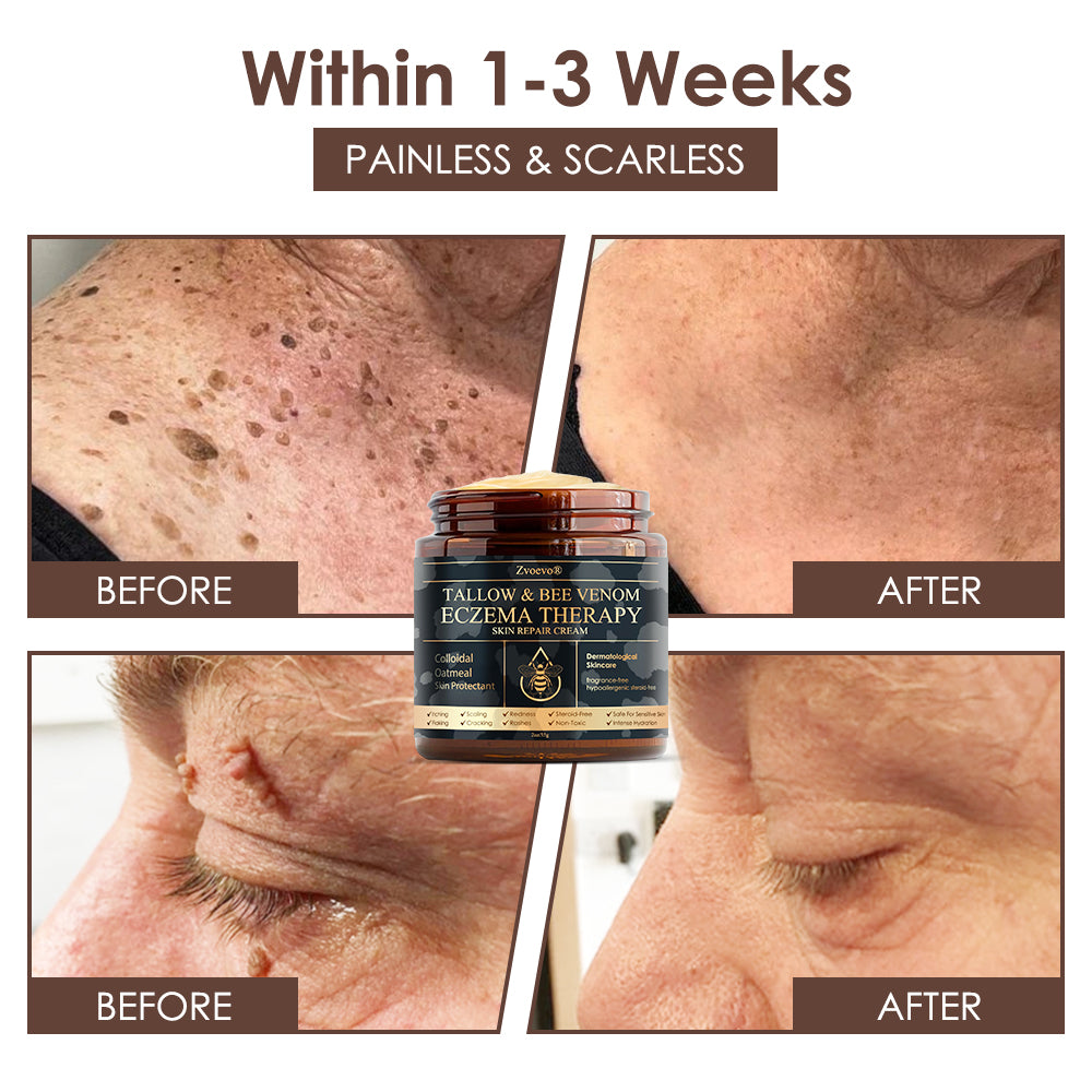 🇺🇸𝗚𝘂𝗮𝗿𝗮𝗻𝘁𝗲𝗲𝗱 𝗻𝗼 𝗿𝗲𝗰𝘂𝗿𝗿𝗲𝗻𝗰𝗲🌿𝐙𝐯𝐨𝐞𝐯𝐨® 𝐓𝐚𝐥𝐥𝐨𝐰 𝐁𝐞𝐞 𝐕𝐞𝐧𝐨𝐦 𝐒𝐤𝐢𝐧 𝐑𝐞𝐬𝐭𝐨𝐫𝐚𝐭𝐢𝐨𝐧 𝐂𝐫𝐞𝐚𝐦🇺🇸𝗠𝗮𝗱𝗲 𝗜𝗻 𝗨𝗦𝗔